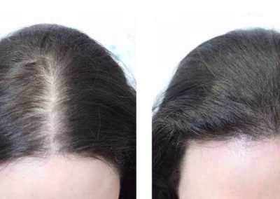 Scalp Micro Pigmentation Procedures in Bangkok, Thailand