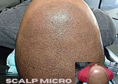 Scalp Micro Pigmentation Procedures in Bangkok, Thailand