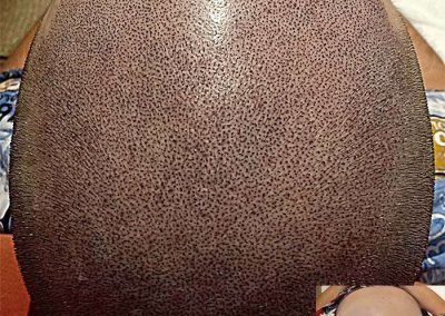 Scalp Micro Pigmentation Procedures in Bangkok, Thailand