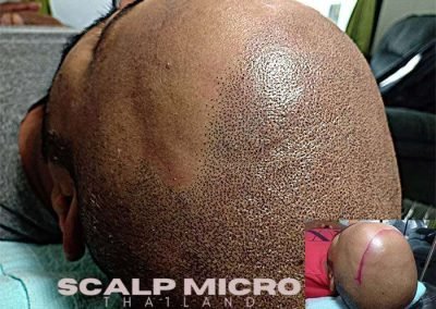 Scalp Micro Pigmentation Procedures in Bangkok, Thailand