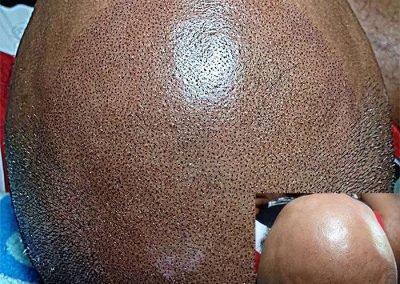 Scalp Micro Pigmentation Procedures in Bangkok, Thailand