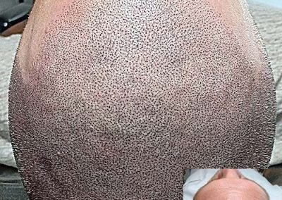 Scalp Micro Pigmentation Procedures in Bangkok, Thailand