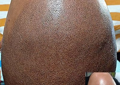 Scalp Micro Pigmentation Procedures in Bangkok, Thailand