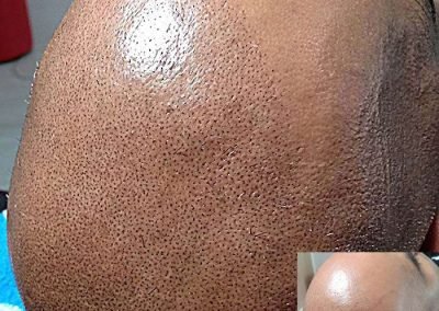 Scalp Micro Pigmentation Procedures in Bangkok, Thailand