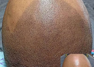 Scalp Micro Pigmentation Procedures in Bangkok, Thailand