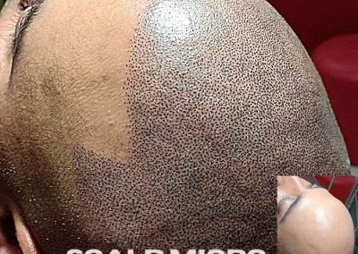 Scalp Micro Pigmentation Procedures in Bangkok, Thailand