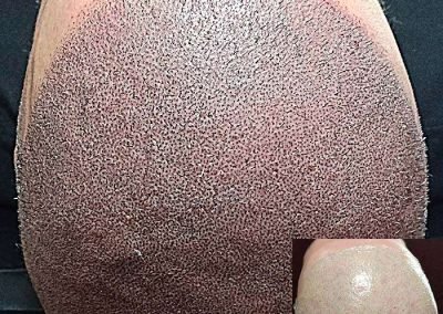 Scalp Micro Pigmentation Procedures in Bangkok, Thailand