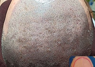Scalp Micro Pigmentation Procedures in Bangkok, Thailand