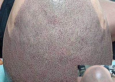 Scalp Micro Pigmentation Procedures in Bangkok, Thailand