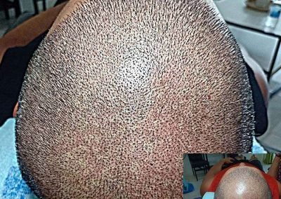 Scalp Micro Pigmentation Procedures in Bangkok, Thailand