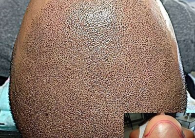 Scalp Micro Pigmentation Procedures in Bangkok, Thailand