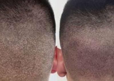 Scalp Micro Pigmentation Procedures in Bangkok, Thailand