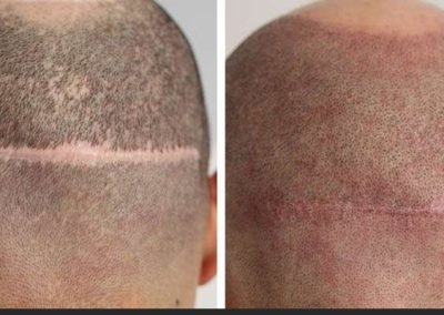 Scalp Micro Pigmentation Procedures in Bangkok, Thailand